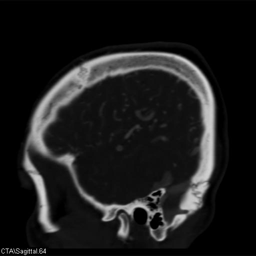 File:Cerebral arteriovenous malformation (Radiopaedia 28518-28759 D 61).jpg