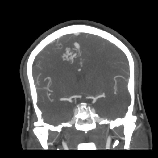 File:Cerebral arteriovenous malformation (Radiopaedia 39259-41505 E 30).png