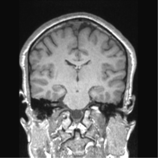 Cerebral arteriovenous malformation (Radiopaedia 39259-41506 Coronal T1 44).png