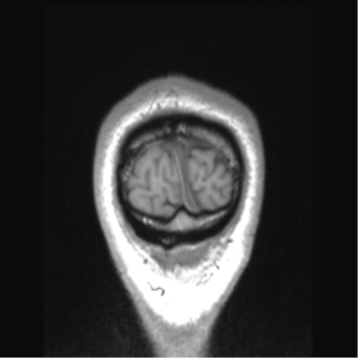 File:Cerebral arteriovenous malformation (Radiopaedia 39259-41506 Coronal T1 6).png