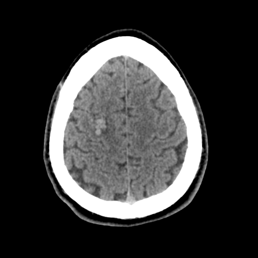File:Cerebral arteriovenous malformation (Radiopaedia 55798-62371 Axial non-contrast 45).png