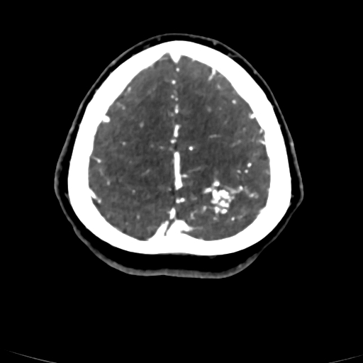 Cerebral arteriovenous malformation (Radiopaedia 73830-84645 Axial C+ delayed 13).jpg