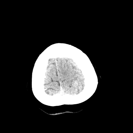 File:Cerebral arteriovenous malformation (Radiopaedia 73830-84645 Axial non-contrast 43).jpg