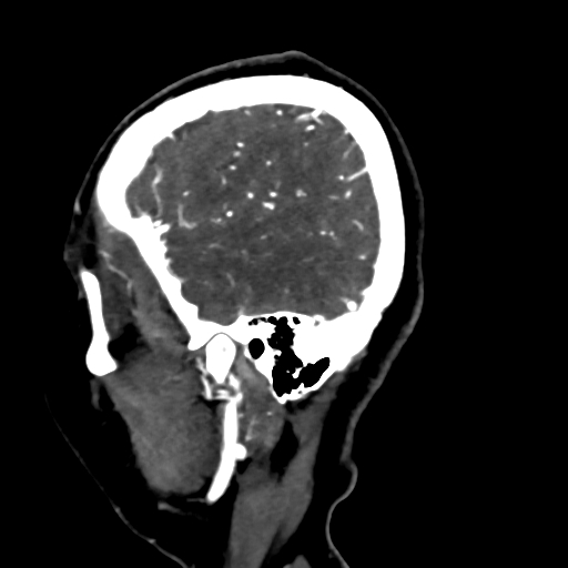 Cerebral arteriovenous malformation (Radiopaedia 73830-84645 Sagittal C+ delayed 78).jpg