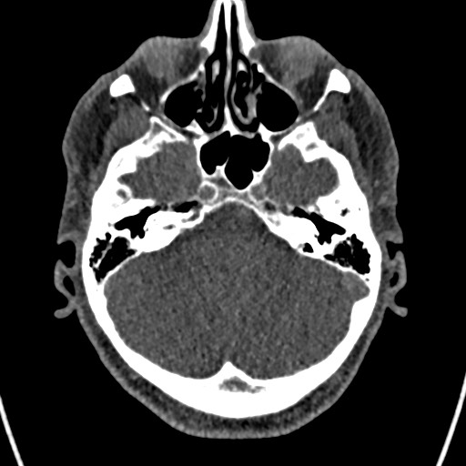 File:Cerebral arteriovenous malformation (Radiopaedia 78188-90746 Axial non-contrast 42).jpg