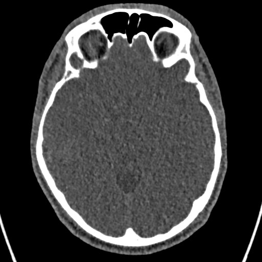 Cerebral arteriovenous malformation (Radiopaedia 78188-90746 Axial non-contrast 73).jpg