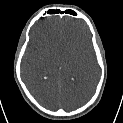 File:Cerebral arteriovenous malformation (Radiopaedia 78188-90746 Axial non-contrast 90).jpg