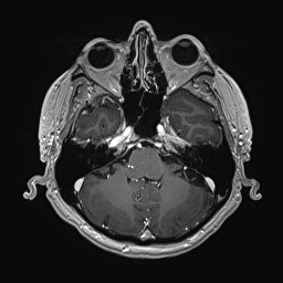 Cerebral arteriovenous malformation (Radiopaedia 84015-99245 Axial T1 C+ 44).jpg