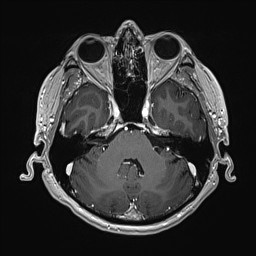 File:Cerebral arteriovenous malformation (Radiopaedia 84015-99245 Axial T1 C+ 49).jpg