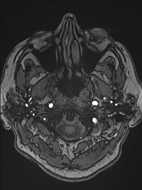 Cerebral arteriovenous malformation (Radiopaedia 84015-99245 Axial TOF 35).jpg