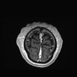 Cerebral arteriovenous malformation (Radiopaedia 84015-99245 Coronal T1 C+ 161).jpg