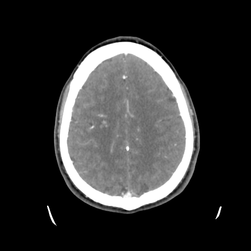 Cerebral arteriovenous malformation (Spetzler-Martin grade 2) (Radiopaedia 41262-44076 Axial C+ 38).png