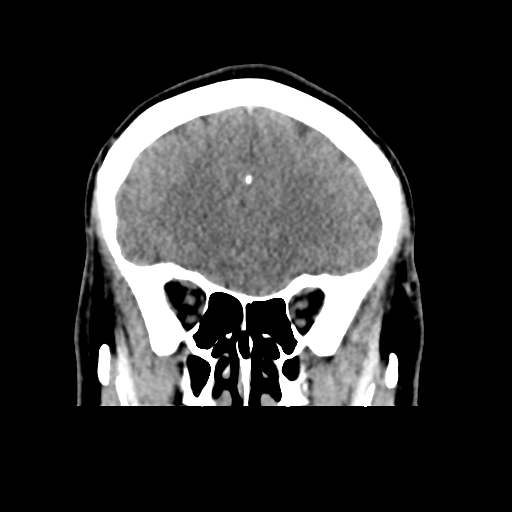 Cerebral arteriovenous malformation (Spetzler-Martin grade 2) (Radiopaedia 41262-44076 Coronal non-contrast 16).png
