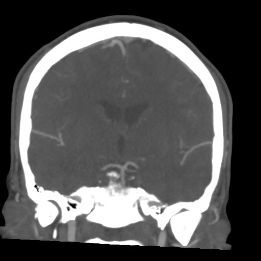 Cerebral arteriovenous malformation (Spetzler-Martin grade 2) (Radiopaedia 41262-44076 F 31).png