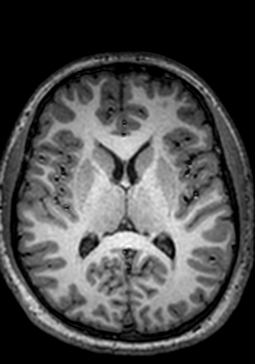 Cerebral arteriovenous malformation at posterior body of corpus callosum (Radiopaedia 74111-84925 Axial T1 135).jpg