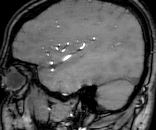 Cerebral arteriovenous malformation at posterior body of corpus callosum (Radiopaedia 74111-84925 J 316).jpg