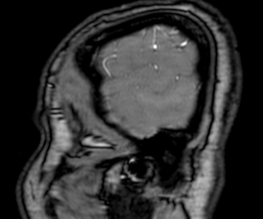 Cerebral arteriovenous malformation at posterior body of corpus callosum (Radiopaedia 74111-84925 J 4).jpg