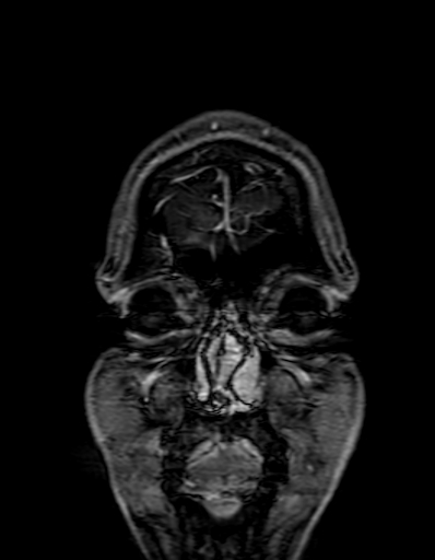 Cerebral arteriovenous malformation at posterior body of corpus callosum (Radiopaedia 74111-84925 K 10).jpg