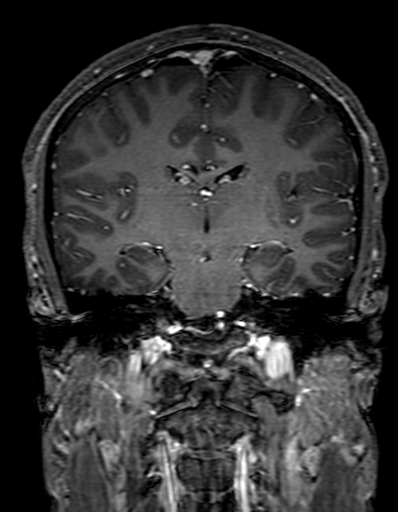Cerebral arteriovenous malformation at posterior body of corpus callosum (Radiopaedia 74111-84925 K 198).jpg