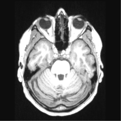 Cerebral arteriovenous malformation with hemorrhage (Radiopaedia 34422-35737 Axial T1 25).png