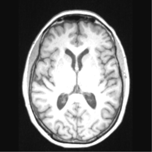 Cerebral arteriovenous malformation with hemorrhage (Radiopaedia 34422-35737 Axial T1 41).png