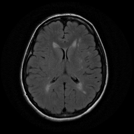 File:Cerebral autosomal dominant arteriopathy with subcortical infarcts and leukoencephalopathy (CADASIL) (Radiopaedia 41018-43763 Ax T2 Flair PROP 12).png
