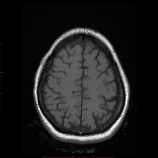 File:Cerebral cavernous malformation (Radiopaedia 26177-26306 Axial T1 17).jpg