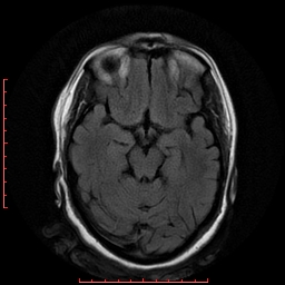 File:Cerebral cavernous malformation (Radiopaedia 26177-26306 FLAIR 9).jpg