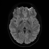 Cerebral cavernous venous malformation (Radiopaedia 70008-80021 Axial DWI 46).jpg