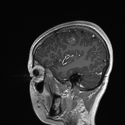 Cerebral cavernous venous malformation (Radiopaedia 70008-80021 Sagittal T1 C+ 16).jpg