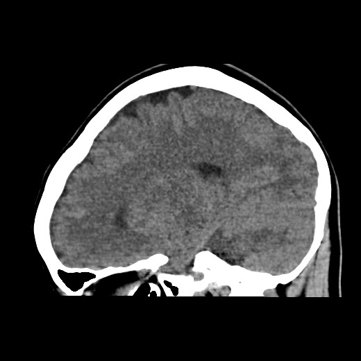 File:Cerebral cavernous venous malformation (Radiopaedia 70008-80022 C 36).jpg