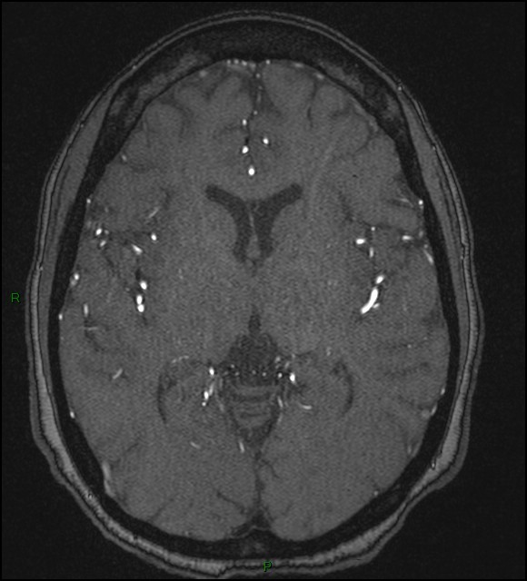 Cerebral fat embolism (Radiopaedia 35022-36525 Axial TOF 105).jpg