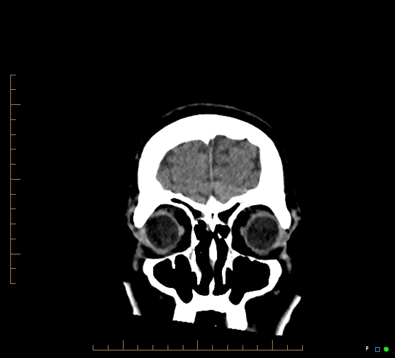 Cerebral fat embolism (Radiopaedia 85521-101220 Coronal non-contrast 10).jpg