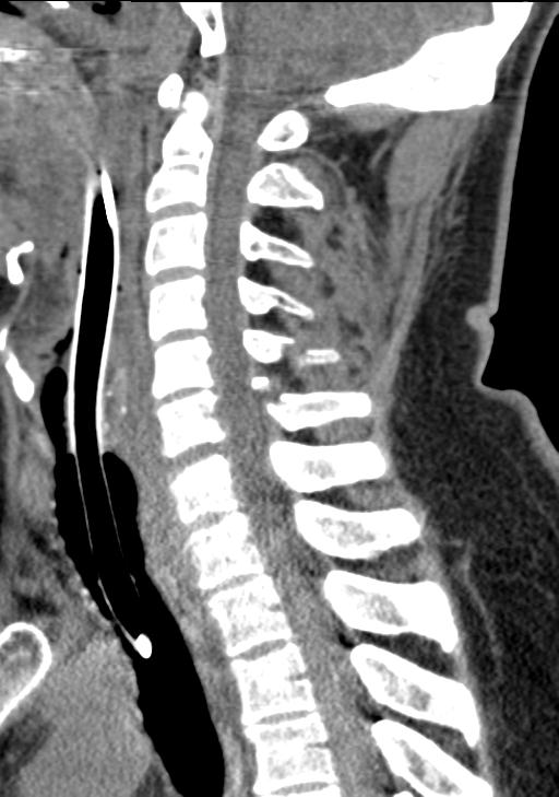 Cerebral hemorrhagic contusions and cervical spine fractures (Radiopaedia 32865-33841 G 57).jpg