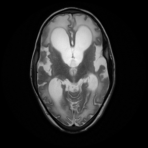 File:Cerebral manifestations of mucopolysaccharidosis type I (Radiopaedia 59171-66487 Axial T2 10).jpg