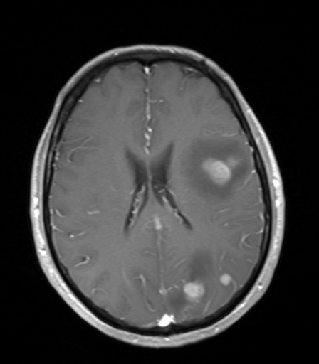 File:Cerebral metastases (Radiopaedia 29781-30303 Axial T1 C+ 1).jpg