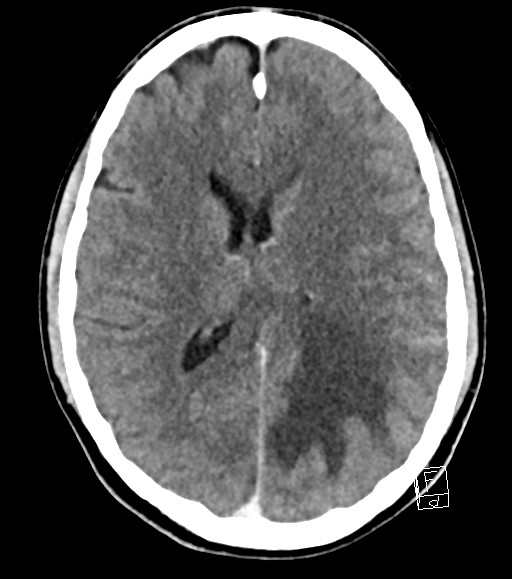 Cerebral metastases - testicular choriocarcinoma (Radiopaedia 84486-99855 Axial C+ delayed 26).jpg