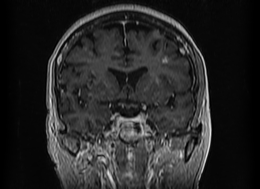 Cerebral metastases from lung cancer with amyloid angiopathy and cerebellopontine angle meningioma (Radiopaedia 74306-85191 Coronal T1 C+ 24).jpg