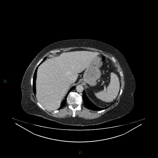 Cerebral metastasis from renal cell carcinoma (Radiopaedia 82306-96378 A 30).jpg