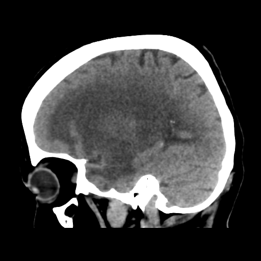 File:Cerebral metastasis to basal ganglia (Radiopaedia 81568-95412 E 21).png