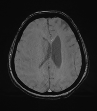File:Cerebral metastasis to basal ganglia (Radiopaedia 81568-95413 Axial SWI magnitude 58).png