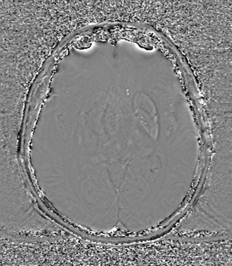 Cerebral metastasis to basal ganglia (Radiopaedia 81568-95413 Axial SWI phase 40).png
