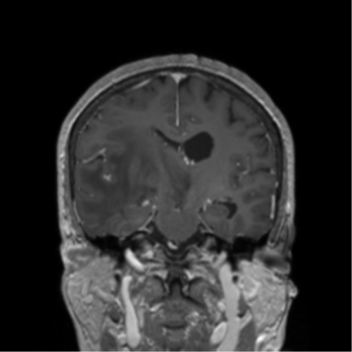 File:Cerebral metastasis to basal ganglia (Radiopaedia 81568-95413 Coronal T1 C+ 24).png