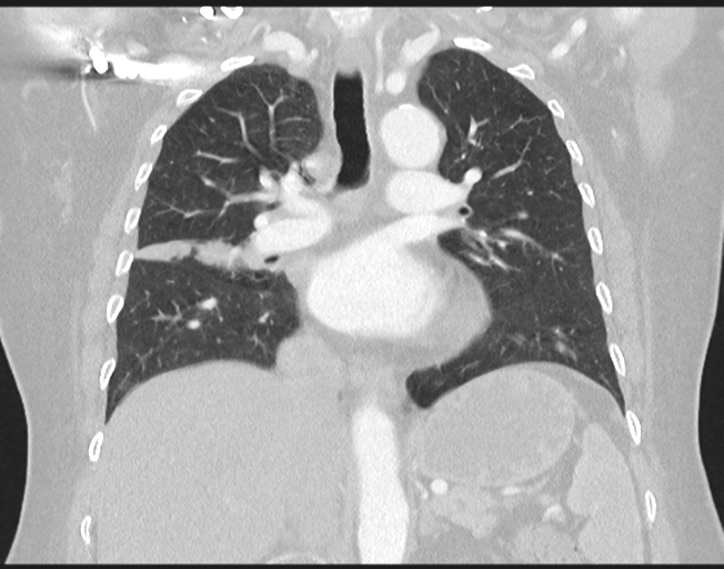 File:Cerebral metastasis to basal ganglia (Radiopaedia 81568-95414 Coronal lung window 47).png