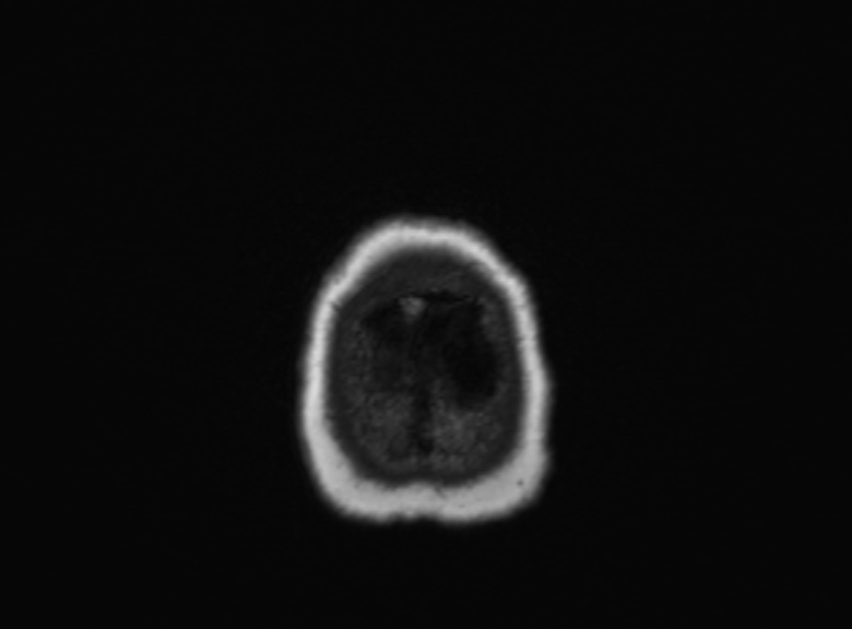 Cerebral ring enhancing lesions - cerebral metastases (Radiopaedia 44922-48817 Axial T1 91).jpg