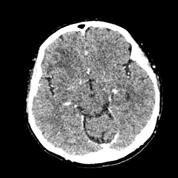 File:Cerebral ring enhancing lesions - cerebral metastases (Radiopaedia 44922-48818 B 121).jpg
