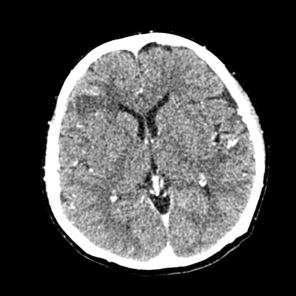 Cerebral ring enhancing lesions - cerebral metastases (Radiopaedia 44922-48818 B 149).jpg