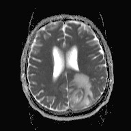 File:Cerebral toxoplasmosis (Radiopaedia 43956-47461 Axial ADC 13).jpg