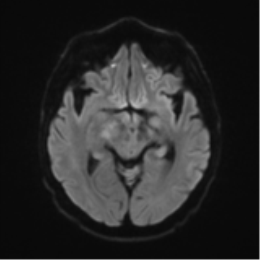 File:Cerebral toxoplasmosis (Radiopaedia 54575-60804 Axial DWI 47).png