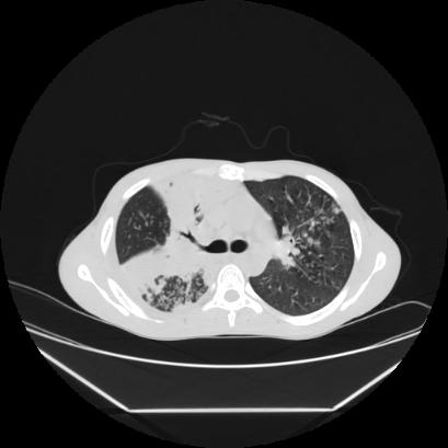 Cerebral tuberculoma (Radiopaedia 80829-94318 Axial lung window 62).jpg
